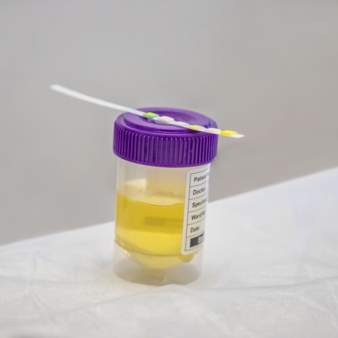 Urine sample with a testing strip on top of it. 